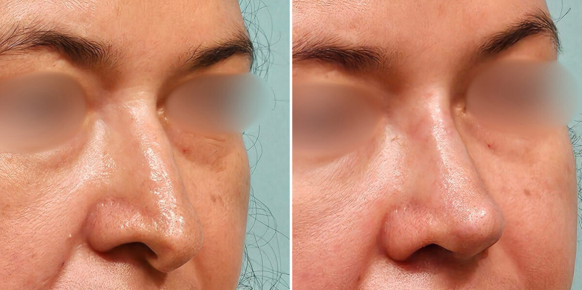 Before and after Revision Rhinoplasty by Dr. Shervin Naderi, Patient 48214