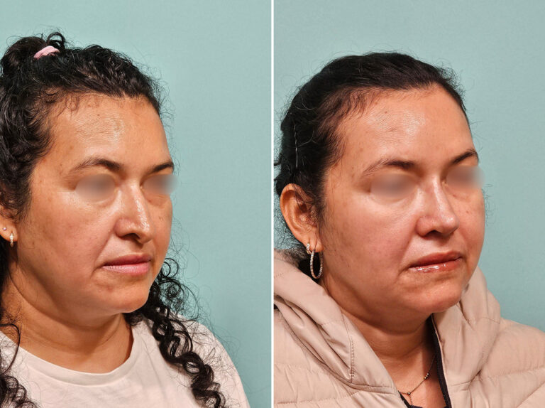 Before and after revision rhinoplasty by Dr. Shervin Naderi: a twisted, drooping nose rebuilt