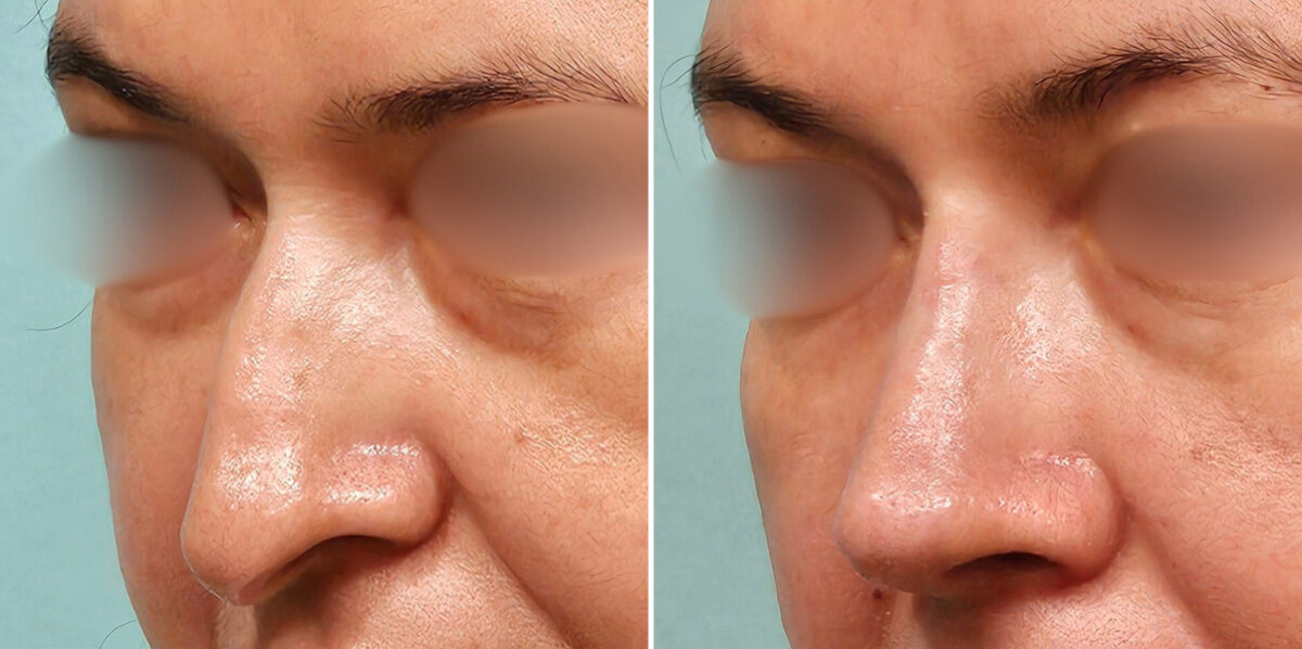 Before and after Revision Rhinoplasty by Dr. Shervin Naderi, Patient 48214