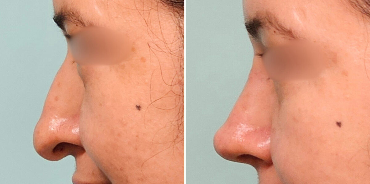 Before and after Revision Rhinoplasty by Dr. Shervin Naderi, Patient 48214