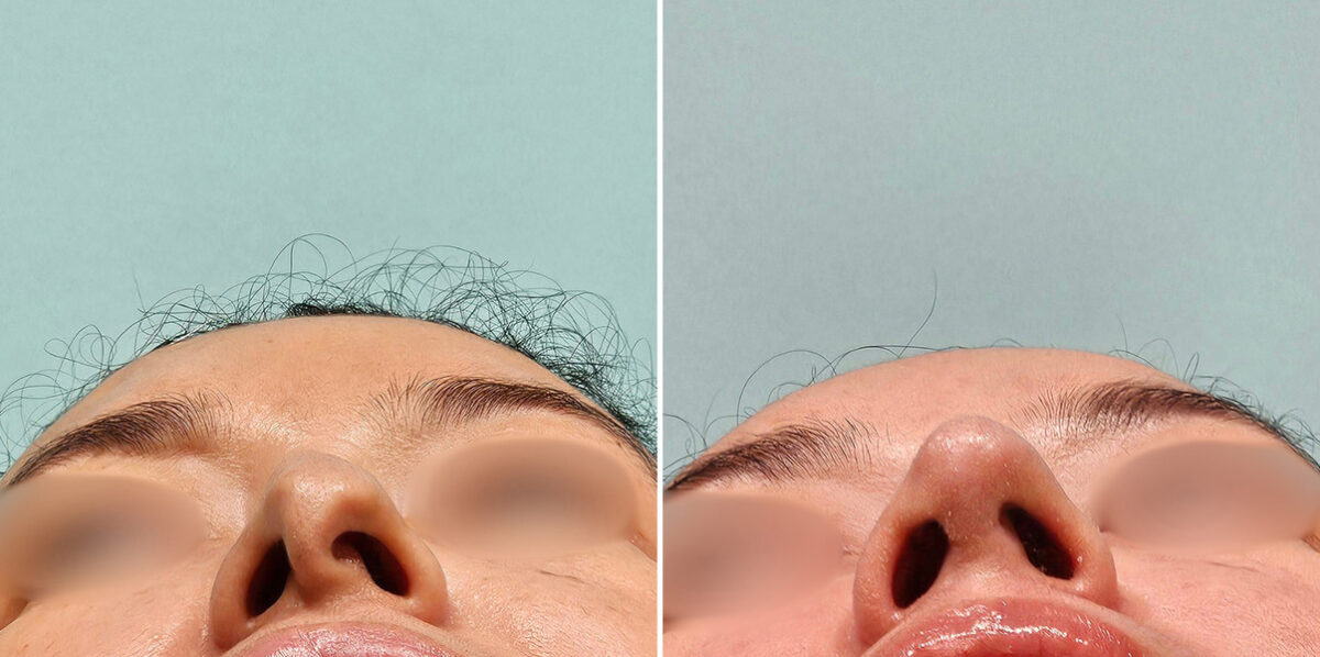 Before and after Revision Rhinoplasty by Dr. Shervin Naderi, Patient 48214