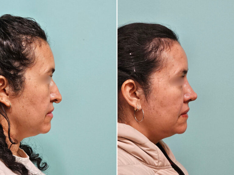 Before and after revision rhinoplasty by Dr. Shervin Naderi: a twisted nose rebuilt