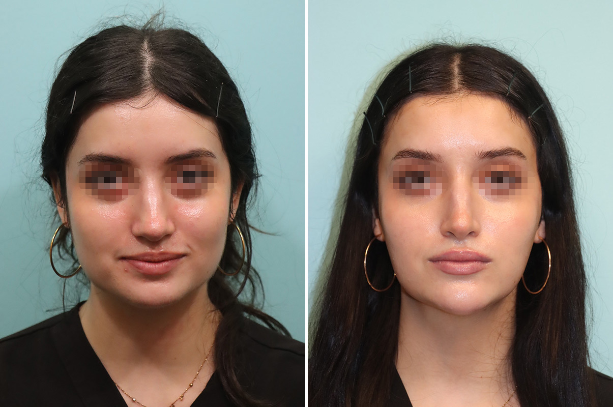 botox before and after for facial slimming masseter injections