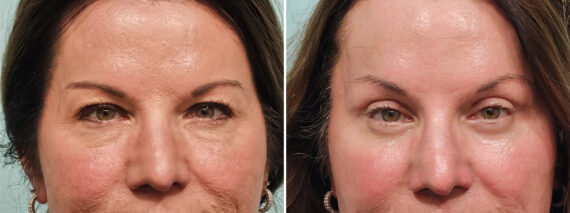 Before and after Blepharoplasty by Dr. Shervin Naderi, Patient 49098