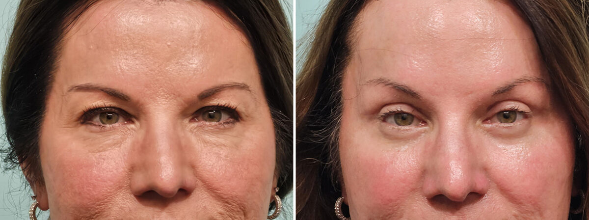 Before and after Brow Lift by Dr. Shervin Naderi, Patient 49201