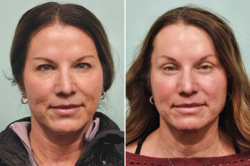 Before and after Brow Lift by Dr. Shervin Naderi, Patient 49201