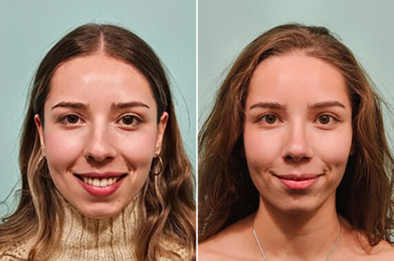 Before and after Rhinoplasty by Dr. Shervin Naderi, Patient 49205