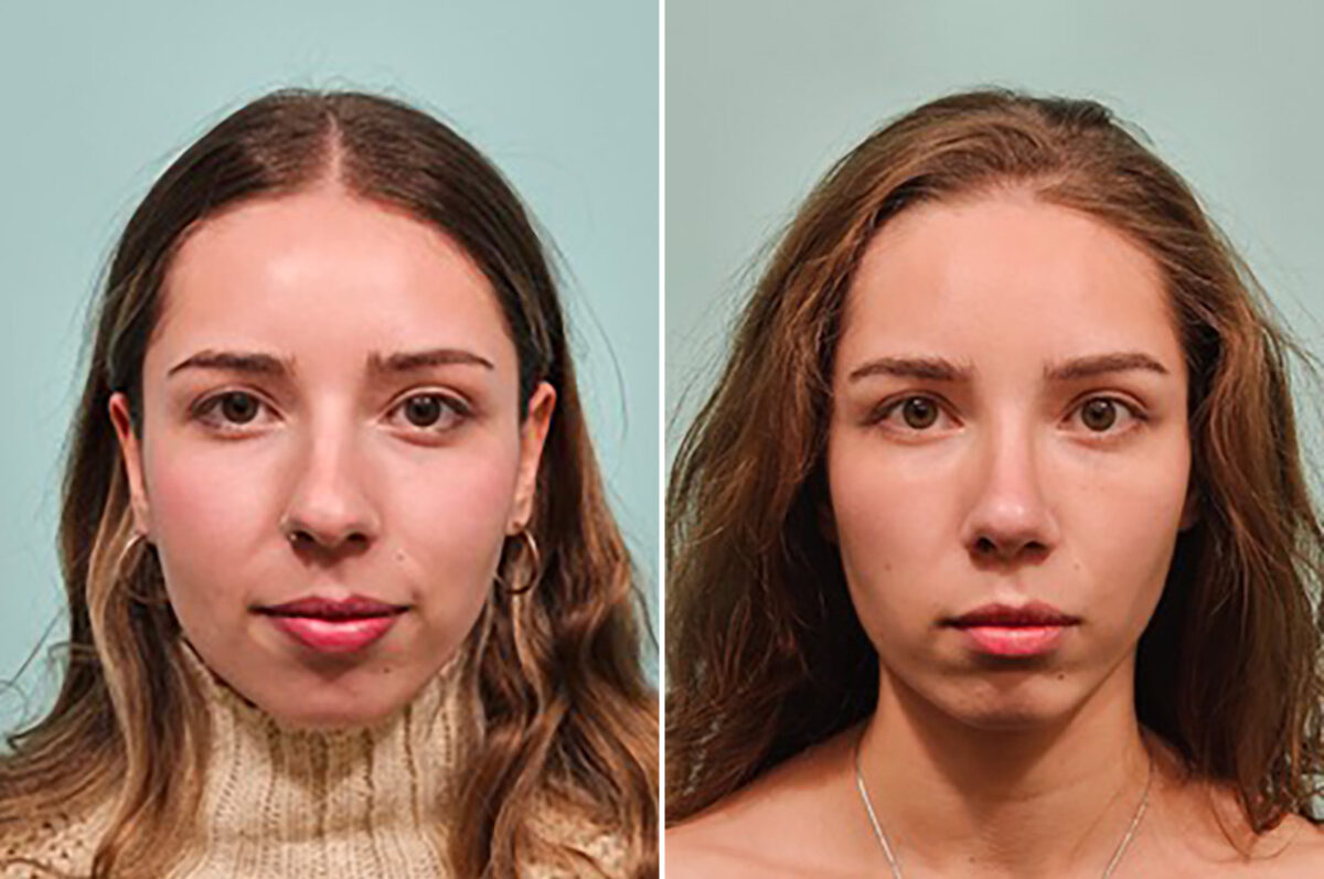 Before and after Rhinoplasty by Dr. Shervin Naderi, Patient 49205