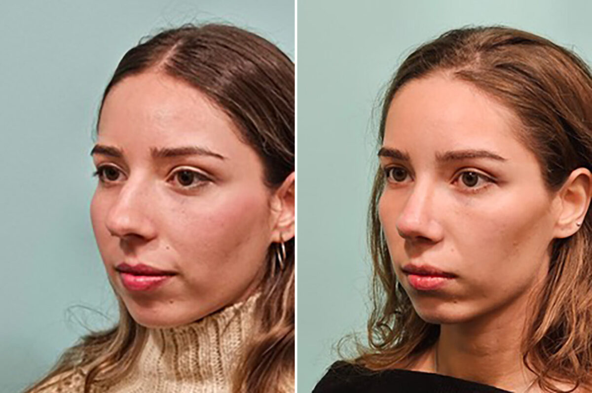 Before and after Rhinoplasty by Dr. Shervin Naderi, Patient 49205
