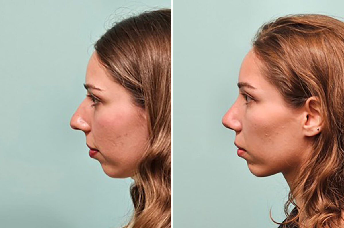 Before and after Rhinoplasty by Dr. Shervin Naderi, Patient 49205