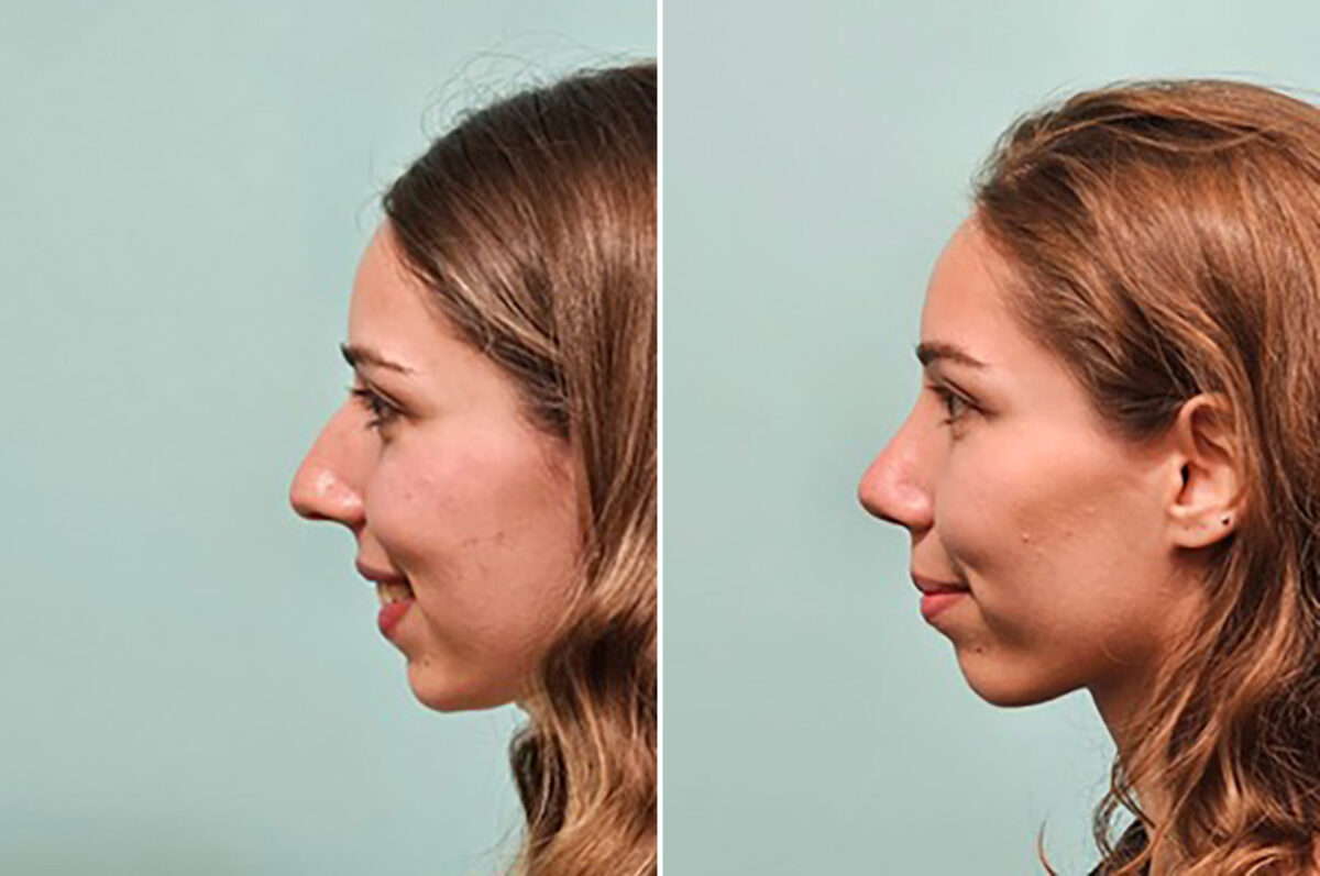 Before and after Rhinoplasty by Dr. Shervin Naderi, Patient 49205