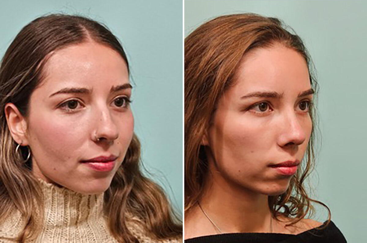 Before and after Rhinoplasty by Dr. Shervin Naderi, Patient 49205