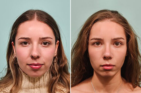 Before and after Rhinoplasty by Dr. Shervin Naderi, Patient 49205