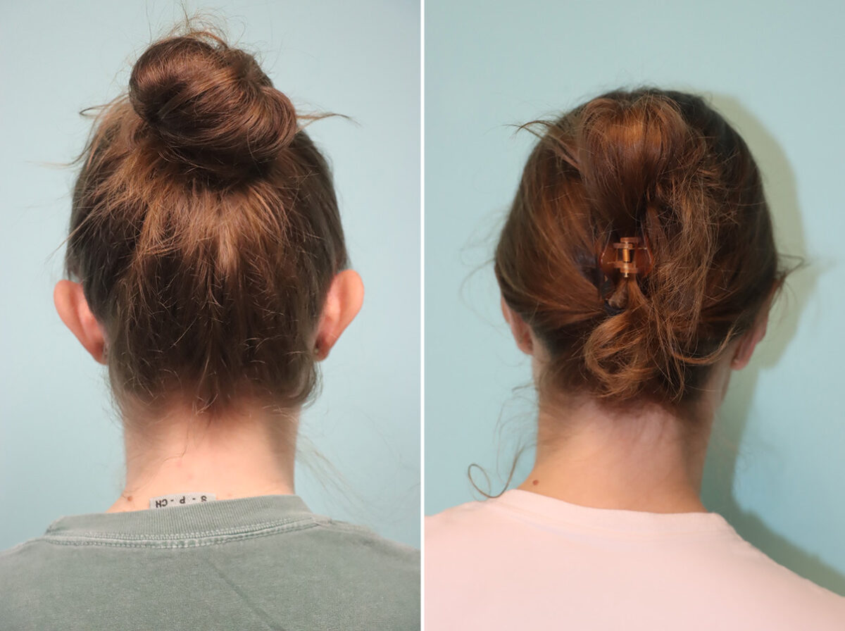 Before and after Otoplasty by Dr. Shervin Naderi, Patient 49230