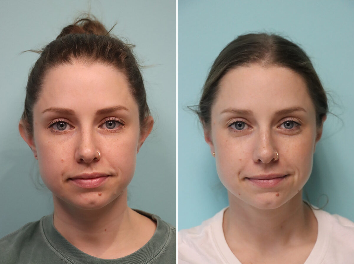 Before and after Otoplasty by Dr. Shervin Naderi, Patient 49230