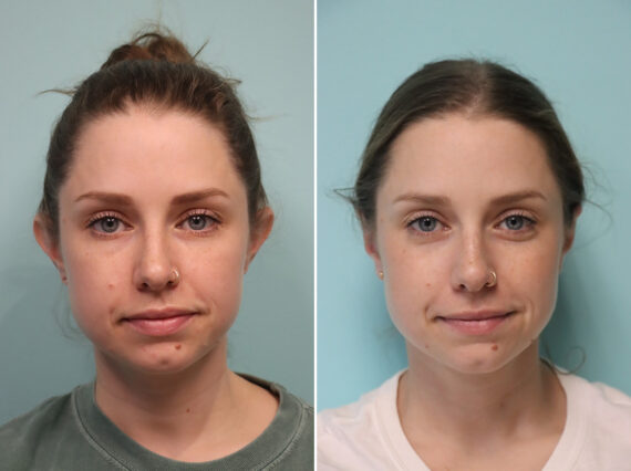 Before and after Otoplasty by Dr. Shervin Naderi, Patient 49230