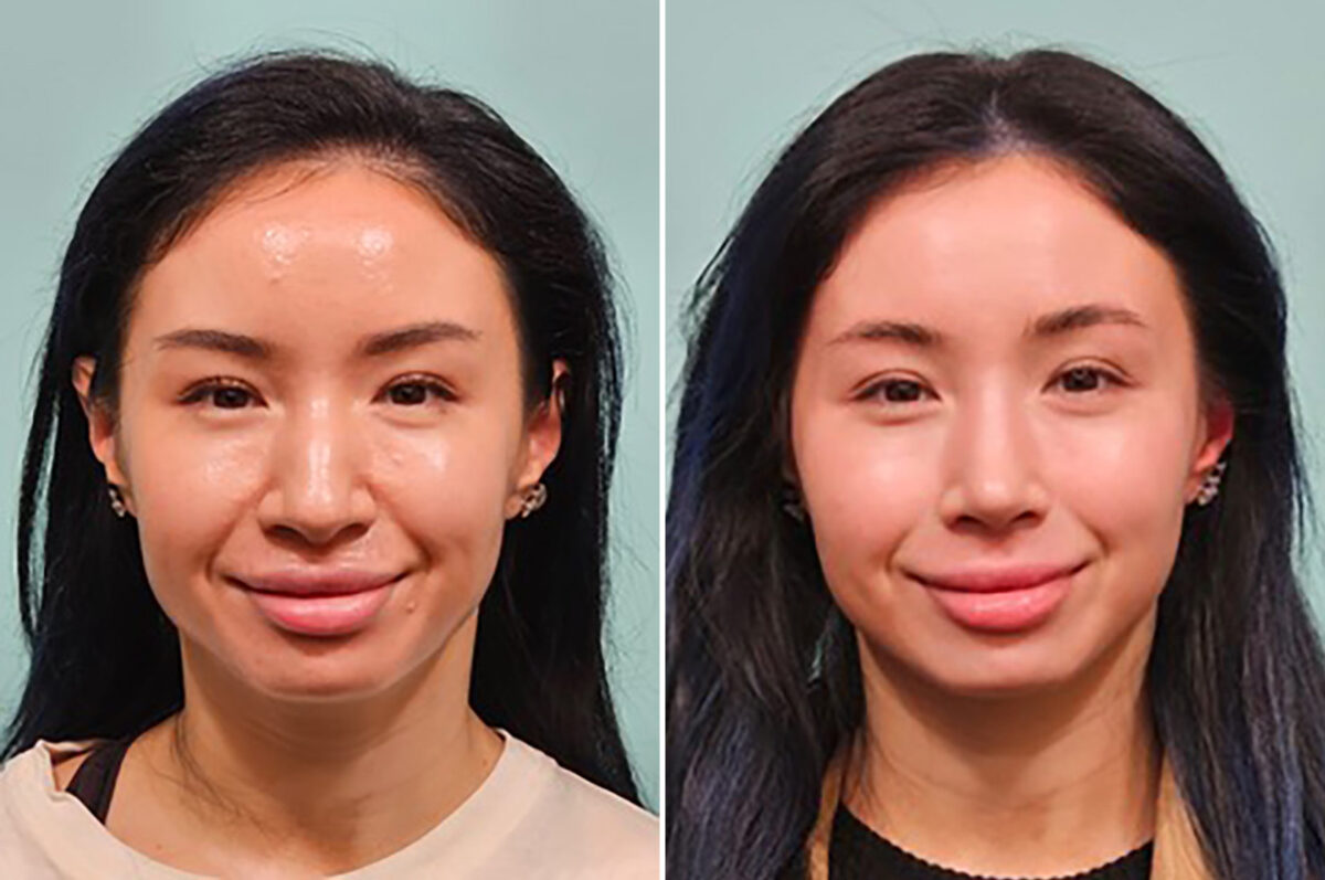 Before and after Rhinoplasty by Dr. Shervin Naderi, Patient 49237