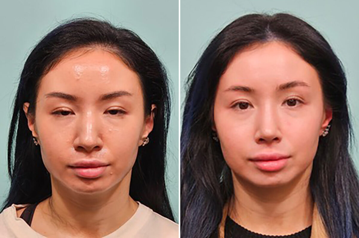 Before and after Rhinoplasty by Dr. Shervin Naderi, Patient 49237