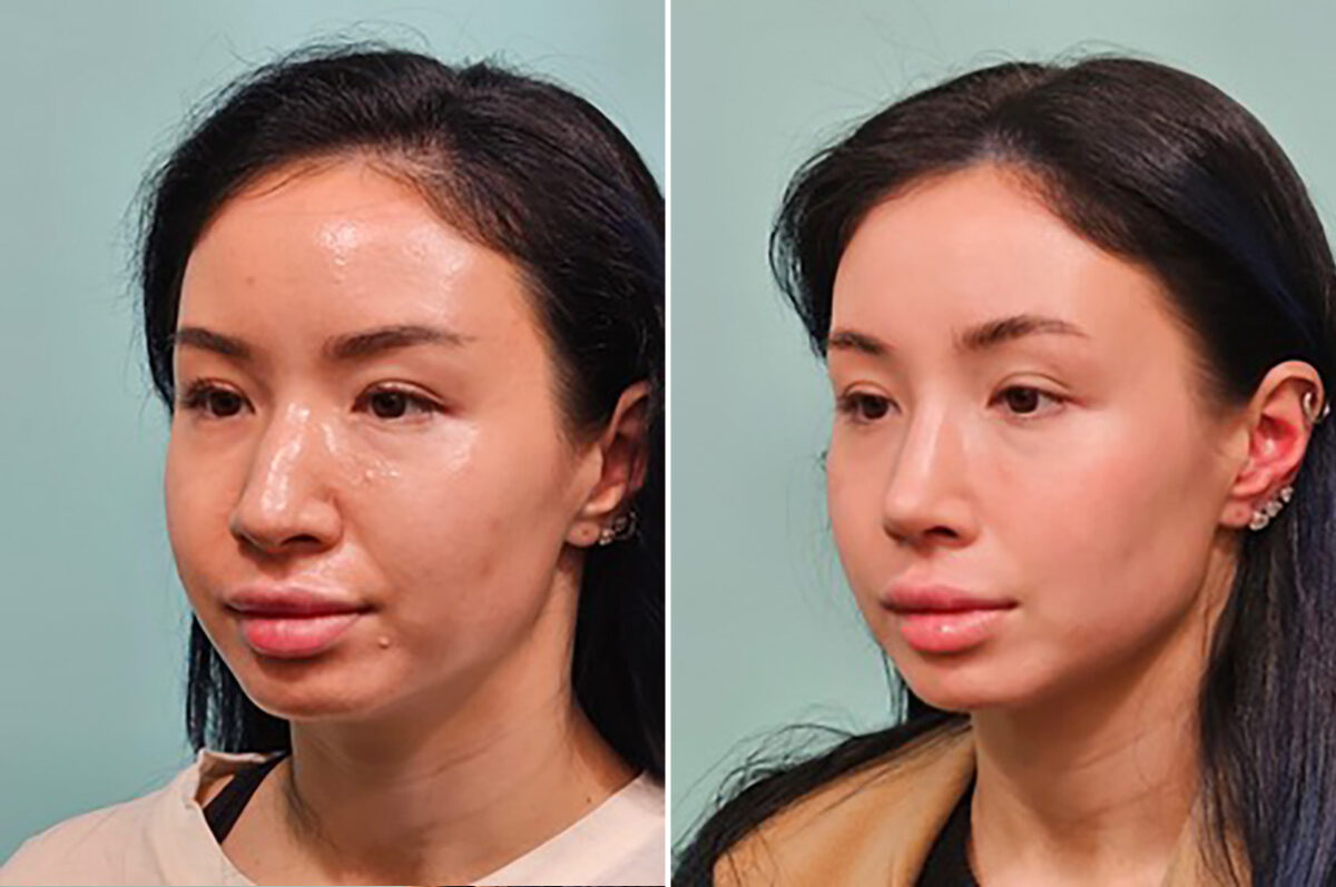 Before and after Rhinoplasty by Dr. Shervin Naderi, Patient 49237