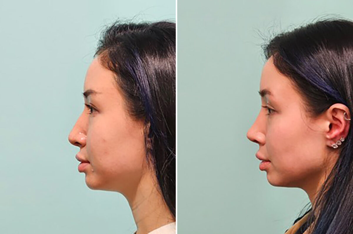 Before and after Rhinoplasty by Dr. Shervin Naderi, Patient 49237