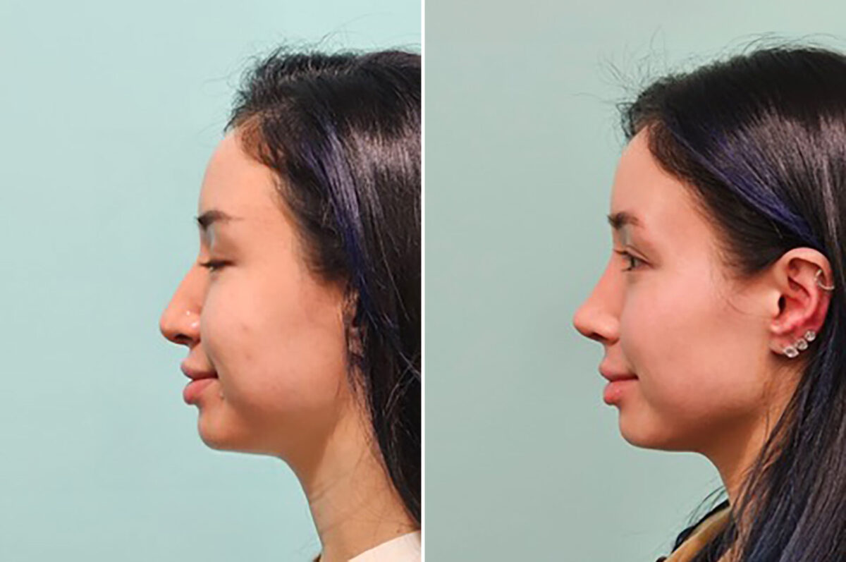 Before and after Rhinoplasty by Dr. Shervin Naderi, Patient 49237