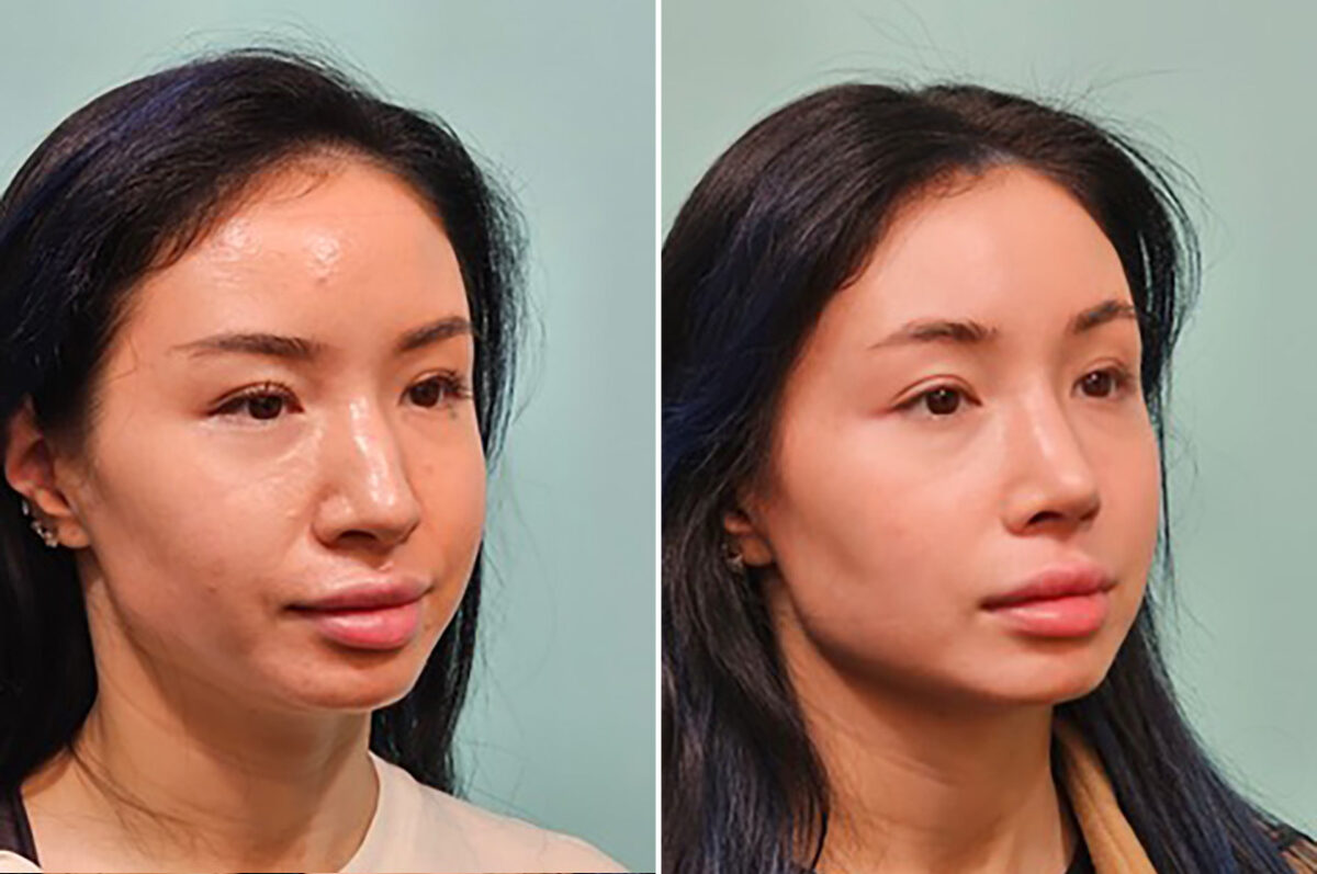 Before and after Rhinoplasty by Dr. Shervin Naderi, Patient 49237
