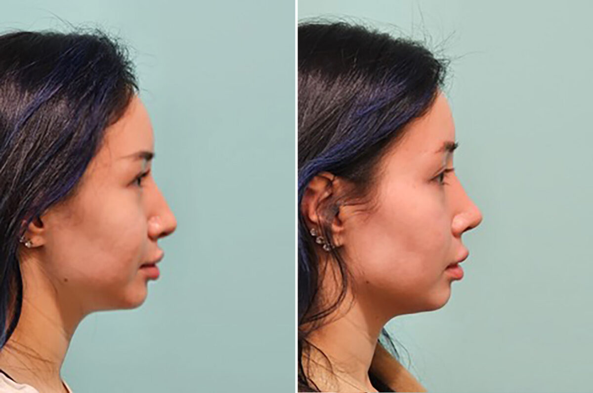 Before and after Rhinoplasty by Dr. Shervin Naderi, Patient 49237