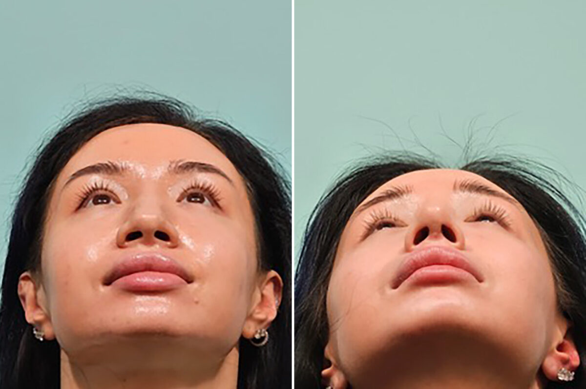 Before and after Rhinoplasty by Dr. Shervin Naderi, Patient 49237