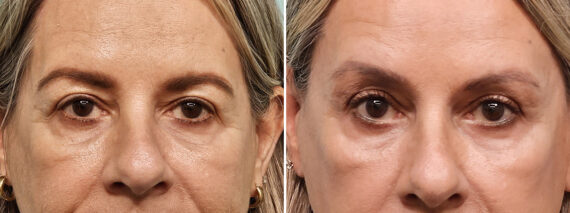 Before and after Brow Lift by Dr. Shervin Naderi, Patient 49262
