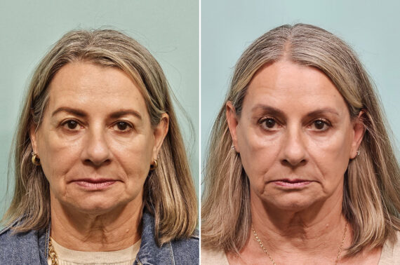 Before and after Brow Lift by Dr. Shervin Naderi, Patient 49262
