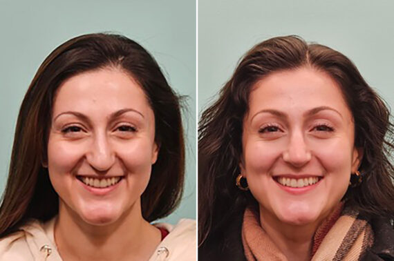 Before and after Rhinoplasty by Dr. Shervin Naderi, Patient 49341