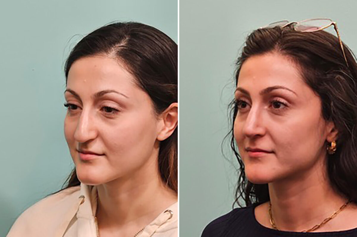 Before and after Rhinoplasty by Dr. Shervin Naderi, Patient 49341