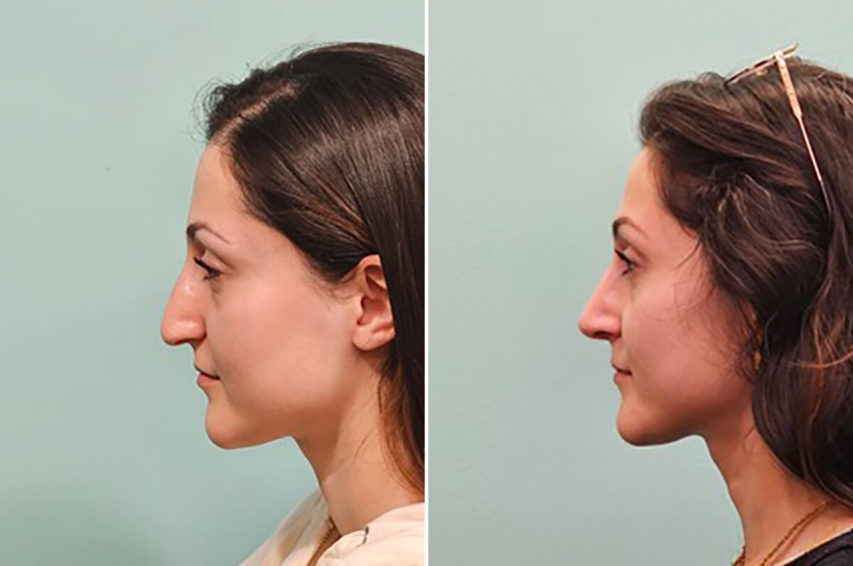 Before and after Rhinoplasty by Dr. Shervin Naderi, Patient 49341
