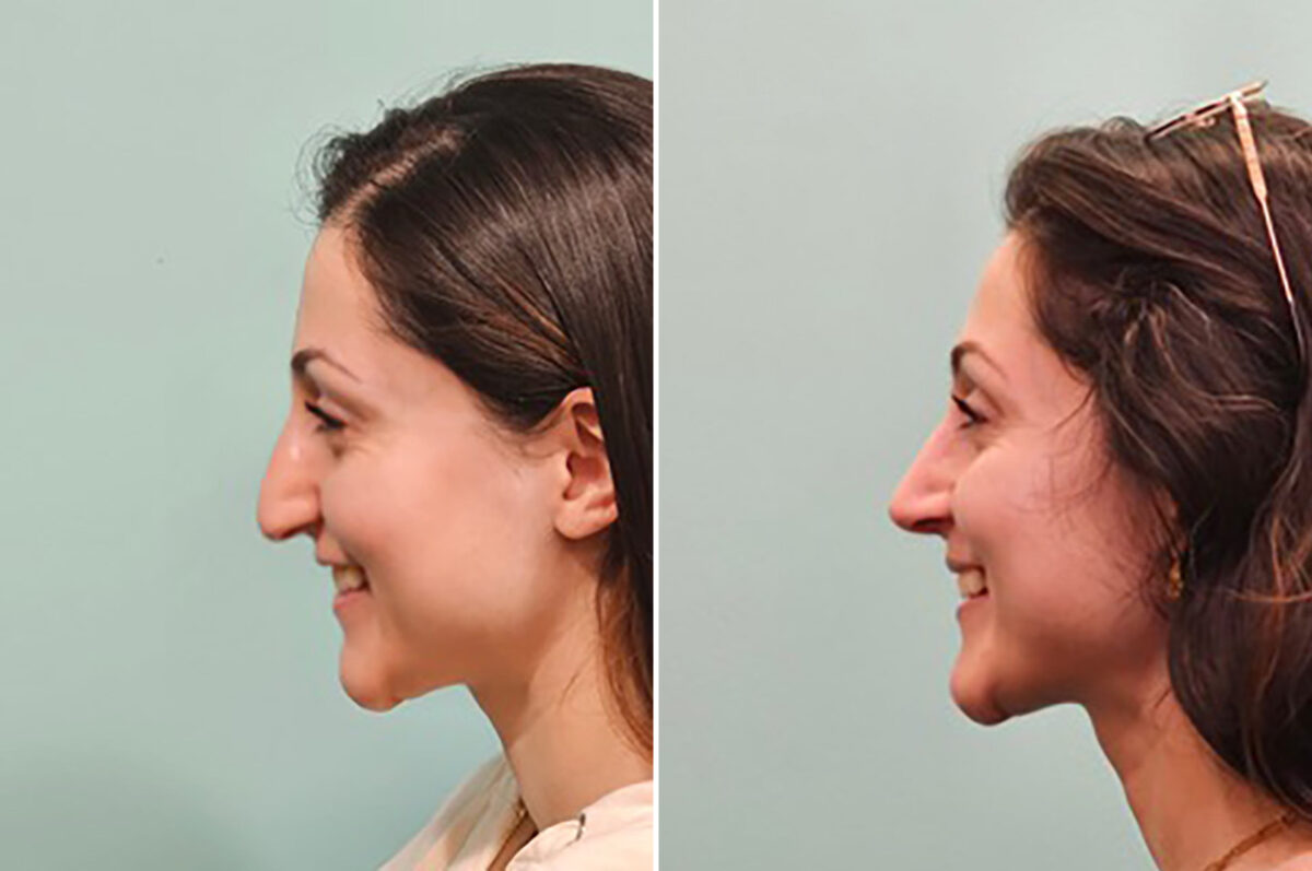 Before and after Rhinoplasty by Dr. Shervin Naderi, Patient 49341