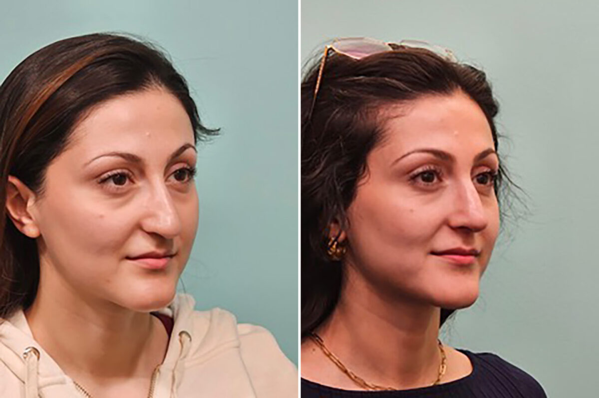 Before and after Rhinoplasty by Dr. Shervin Naderi, Patient 49341