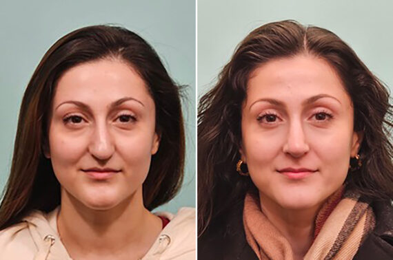Before and after Rhinoplasty by Dr. Shervin Naderi, Patient 49341