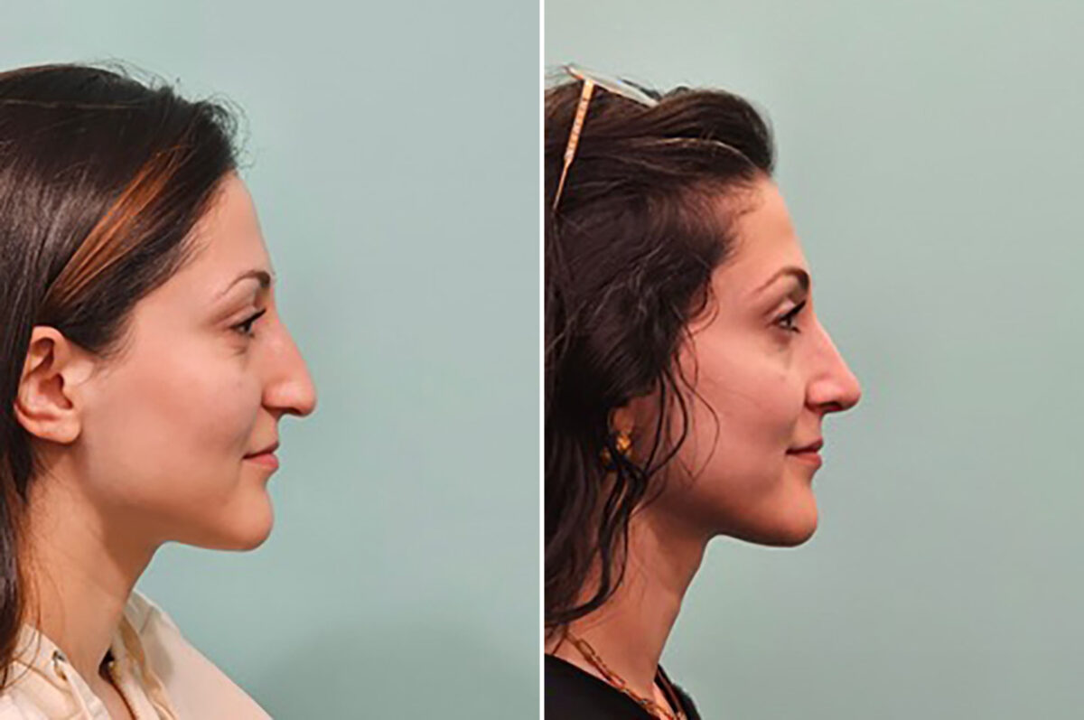 Before and after Rhinoplasty by Dr. Shervin Naderi, Patient 49341