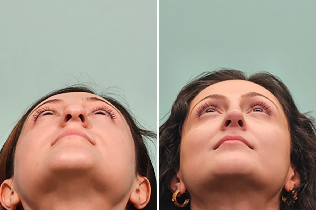 Before and after Rhinoplasty by Dr. Shervin Naderi, Patient 49341