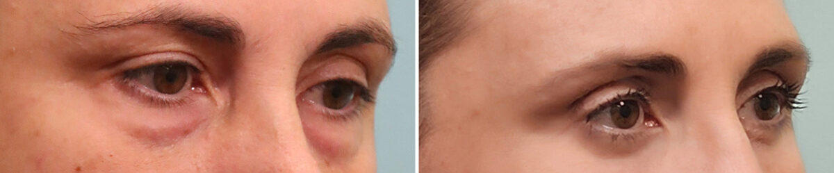 Before and after Blepharoplasty by Dr. Shervin Naderi, Patient 49427