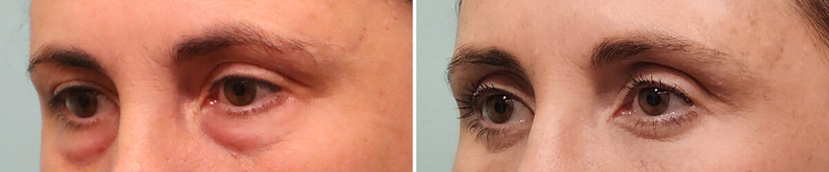 Before and after Blepharoplasty by Dr. Shervin Naderi, Patient 49427