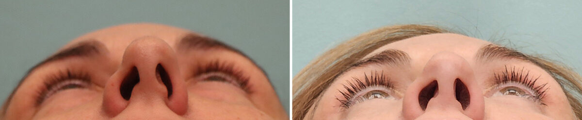 Before and after Blepharoplasty by Dr. Shervin Naderi, Patient 49427