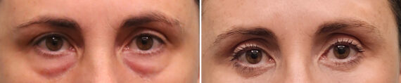 Before and after Blepharoplasty by Dr. Shervin Naderi, Patient 49427