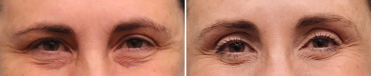 Before and after Blepharoplasty by Dr. Shervin Naderi, Patient 49427