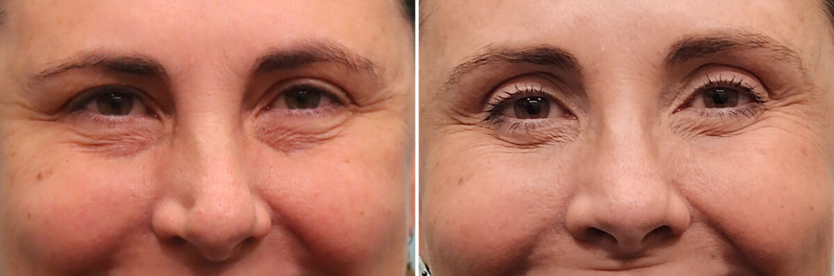 Before and after Rhinoplasty by Dr. Shervin Naderi, Patient 49451