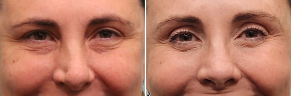 Before and after Rhinoplasty by Dr. Shervin Naderi, Patient 49451