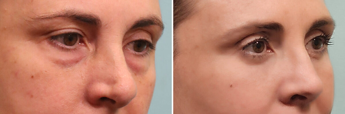 Before and after Rhinoplasty by Dr. Shervin Naderi, Patient 49451