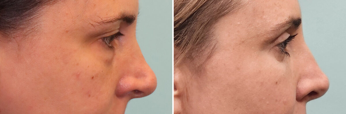 Before and after Rhinoplasty by Dr. Shervin Naderi, Patient 49451