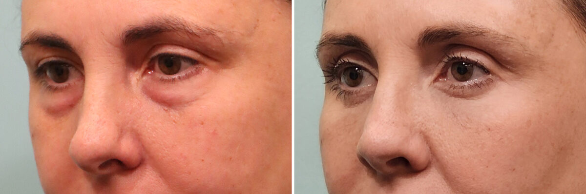 Before and after Rhinoplasty by Dr. Shervin Naderi, Patient 49451