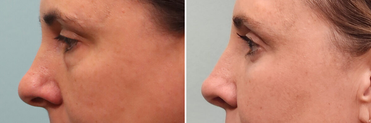 Before and after Rhinoplasty by Dr. Shervin Naderi, Patient 49451