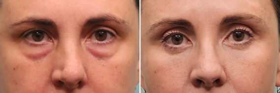 Before and after Rhinoplasty by Dr. Shervin Naderi, Patient 49451